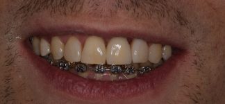 implanto-ortodoncja-po