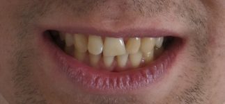 implanto-ortodoncja-przed